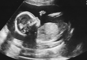 Baby Profile Sonogram Ultrasound