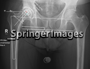 hip prosthesis under equation of a preoperative leg length difference