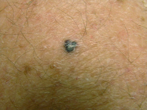 malignant melanoma skin cancer source http quoteko com ...