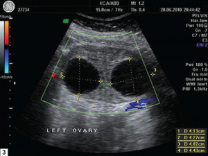 polycystic ovaries ultrasound