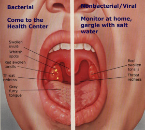 tonsillitis Images and Graphics