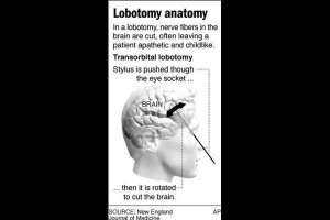 Image of Lobotomy
