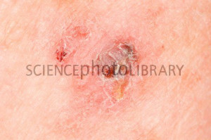 Melanoma Skin Cancer Spread