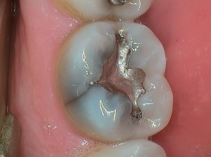 These are some of How Repair Broken Fractured Cracked Tooth pictures