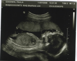 Week Anatomy Scan Ultrasound And