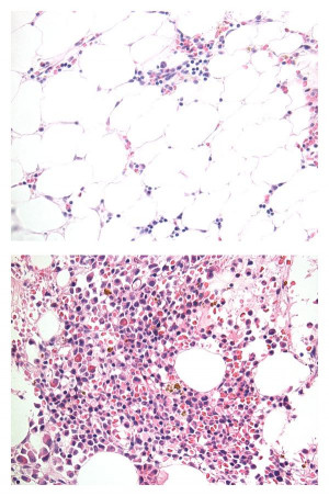 Aplastic Anemia Bone Marrow