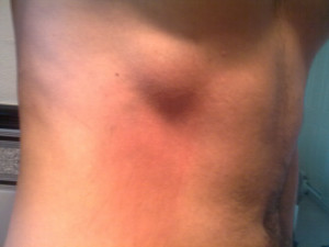 Broken Ribs Images Took...