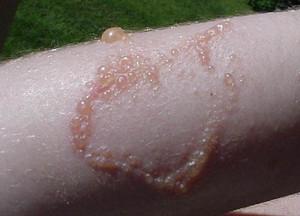 Poison Ivy Rash Treatment