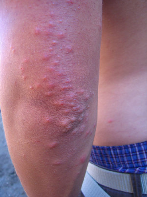 bed bug bites on arm