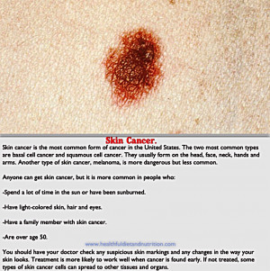 skin cancer on stomach