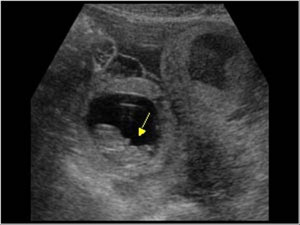 Ectopic Pregnancy Ultrasound