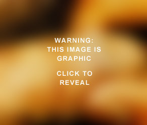 sexually transmitted diseases warts