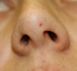 Blood Blister On Face