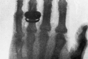 One of the first X-ray photographs, taken by German physicist Wilhelm ...
