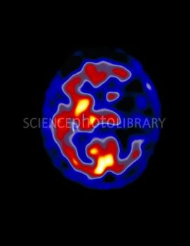 Coloured Pet Scan Of The Brain Of A Stroke Patient