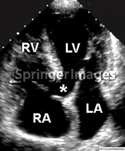 Tetralogy of Fallot Echocardiogram