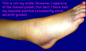 What Does a Sprained Ankle Look Like