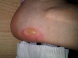 Spider Bite Blister
