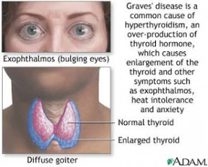 description hyperthyroidism is a hyperthyroid state resulting from ...
