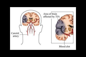 Transient ischemic attack Picture Slideshow