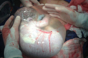 Doctor posts ultra-rare photo of newborn baby still in amniotic sac