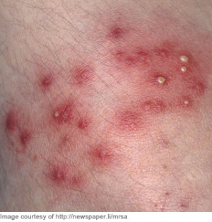 Patient Presents With Back Pain Amp Rash