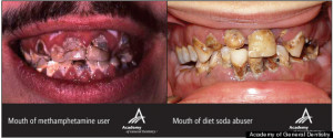 Diet Soda's Effect On Teeth Terrifyingly Similar To Effects Of Meth ...