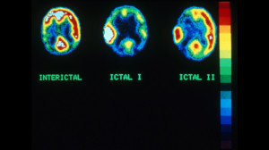 Epilepsy Brain Scan MRI