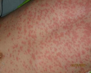 Chicken Pox vs Measles Rash