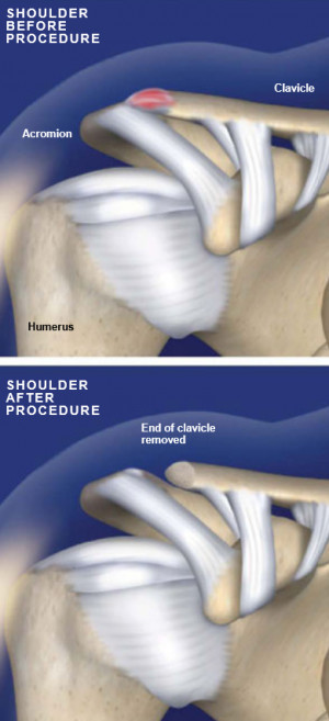 _muscle/Shoulder/surgical-procedures/distal-clavicle-excision.htm