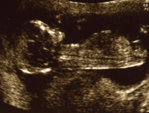 Healthy baby ultrasound picture.PNG