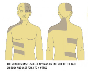 does exposure to chickenpox cause shingles