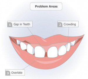 Necessary Points before Going for Teeth Braces Treatment, Points ...