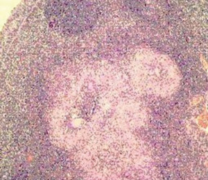 Smear Showing Characteristic Cording In Mycobacterium Tuberculosis