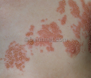 Skin Disease Herpes Zoster