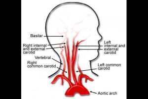 Common Carotid Artery