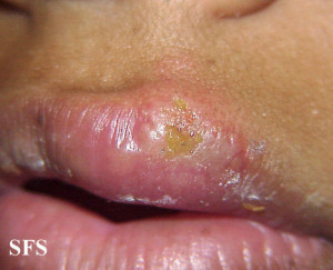 Fever Blister On Cheek Herpes facialis herpes of the