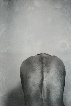 scoliosis. painful everyday. More