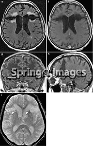 Bilateral prefrontal lobotomy. The patient has a history of ...