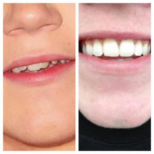 Girls With Braces Tumblr Quotes Quote: