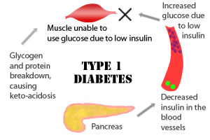 type1 diabetes once referred to as juvenile diabetes or insulin ...