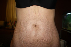 stretch marks during pregnancy. http://www.thehealthsite.com/pregnancy ...