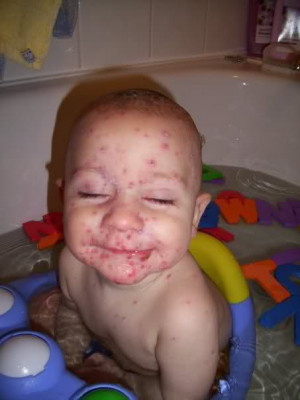 Re: Chicken pox ... looking really sore on face