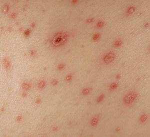 Images, Pics, Pictures and Photos of Fungal Rash