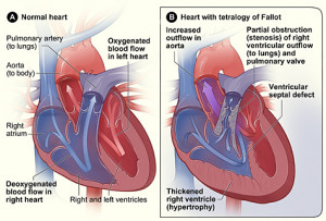 Figure A shows the structure and blood flow inside a normal heart ...