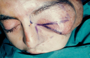 Neurofibromatosis Images