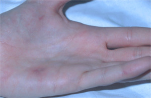 Endocarditis Janeway Lesions