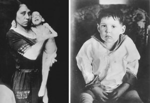 year-old Leonard Thompson, before, and several weeks after receiving ...