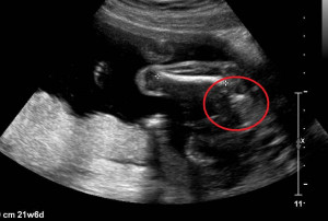 20 Week Ultrasound Boy vs Girl