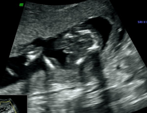 15 Week Ultrasound Boy or Girl